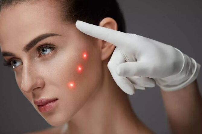 Laser Rejuven vun der Haut