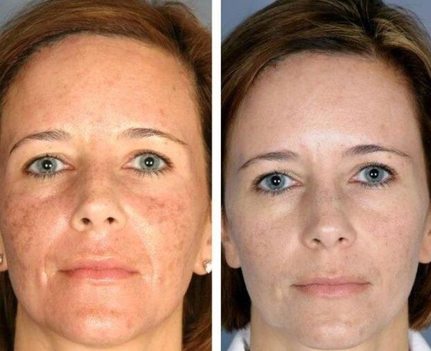 Laser Rejuvenatioun