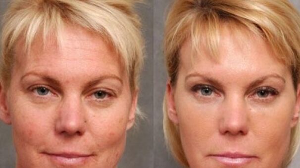 Virun an no der Rejuvenation Prozedur